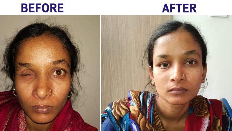 First Customized Ocular Prosthesis