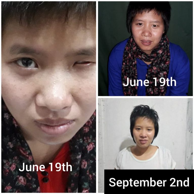 Successful Customized ocular prosthesis
