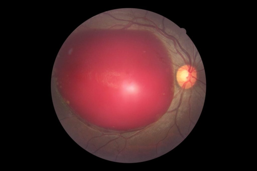 Retina photograph showing a large red area with blood vessels and a bright light reflex