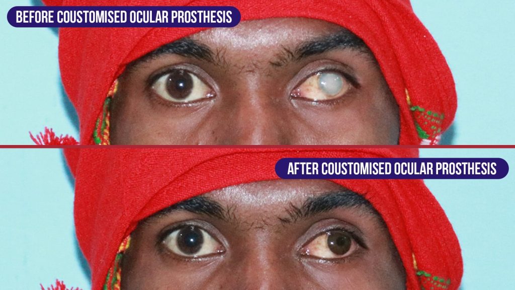 before and after customized ocular prosthesis treatment