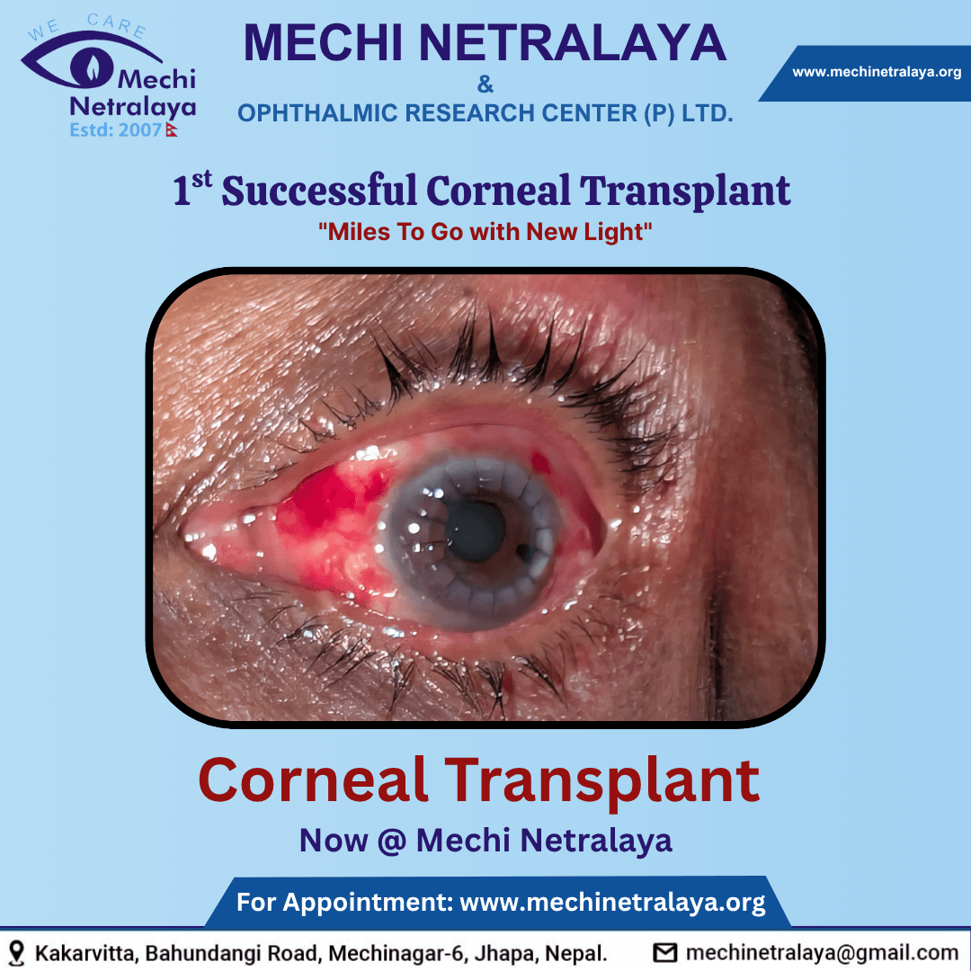 close-up of human eye with corneal transplant text overlay