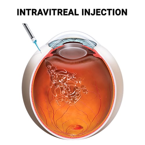 Anatomy of eye with intravitreal injection procedure