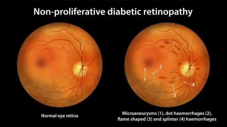 Non-Proliferative Diabetic Retinopathy Non-Proliferative Diabetic Retinopathy