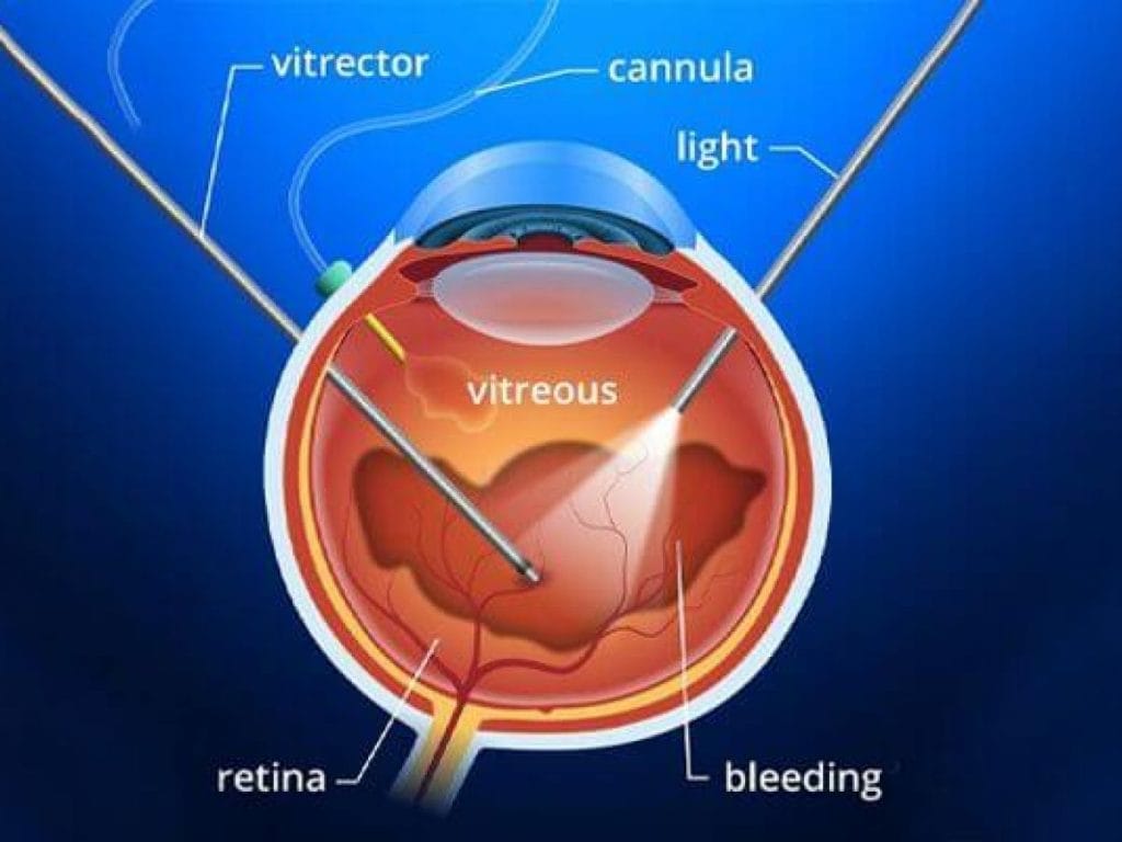 Vitreo-Retina Surgery