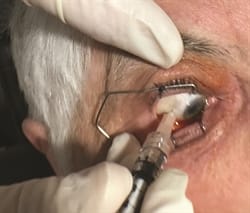 Intravitreal Injections Vitreo-Retina Surgery