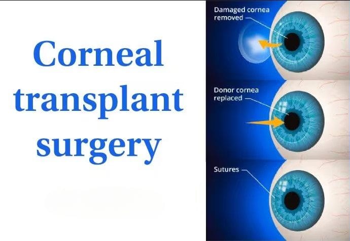 Corneal transplant surgery process with damaged cornea removal and donor cornea replacement