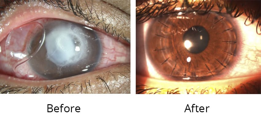 Penetrating Keratoplasty (PKP)