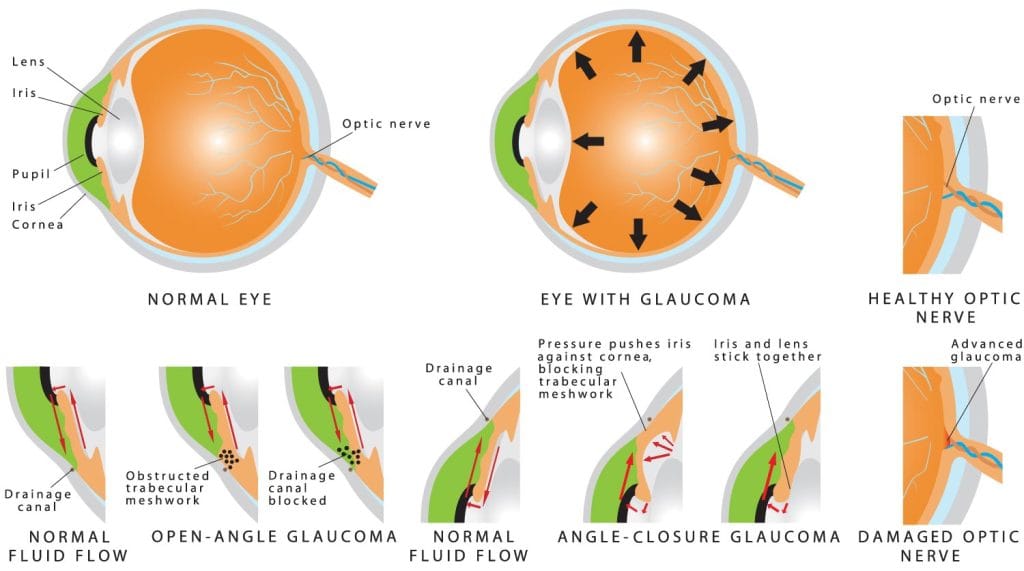 Glaucoma-awareness-month-screening-at-Mechi-Netralaya-eye-hospital-Jhapa