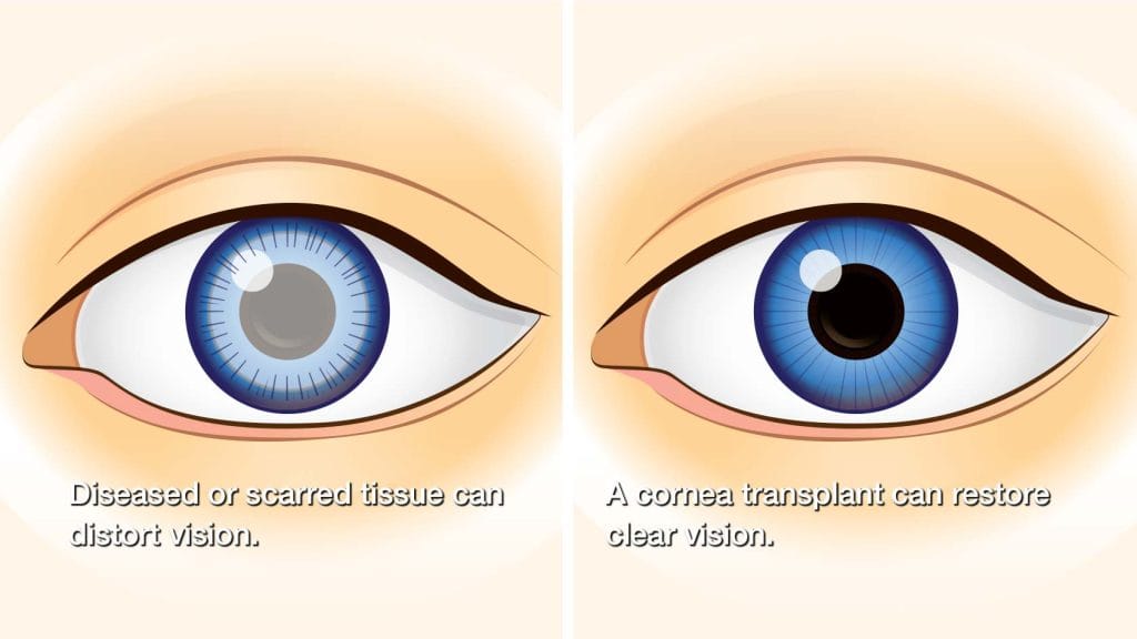 Corneal-Transplant-Procedure