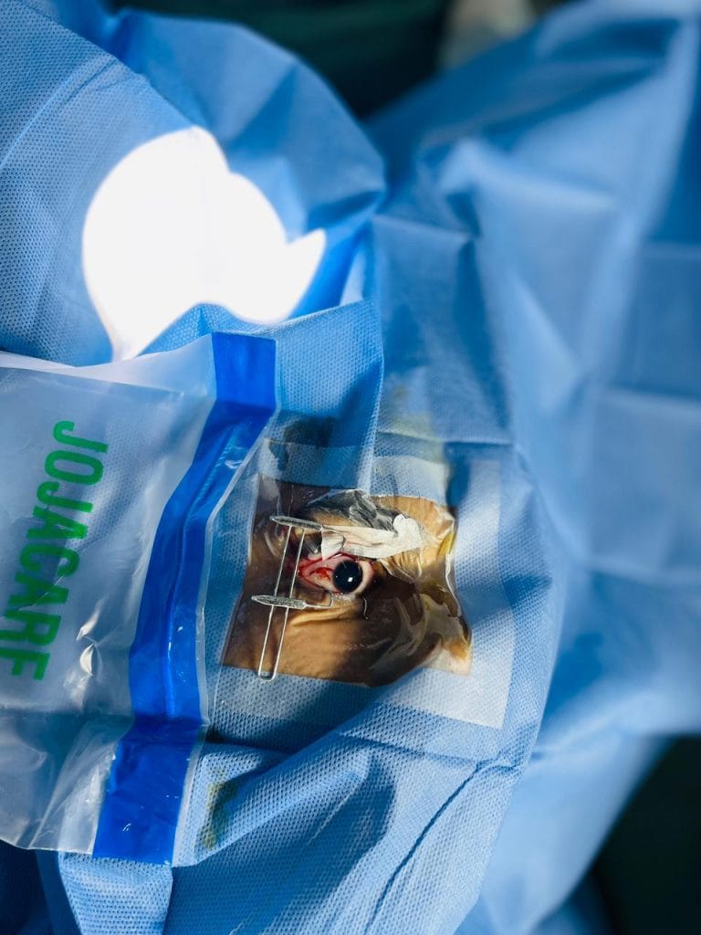 introcular-phakic-contact-lens-ipcl