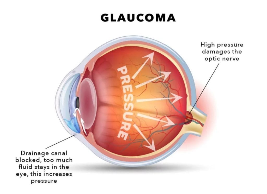 Glaucoma-Clinic-Nepal