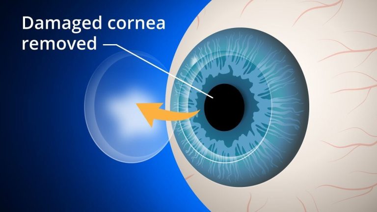 Damaged cornea being removed from a blue eye