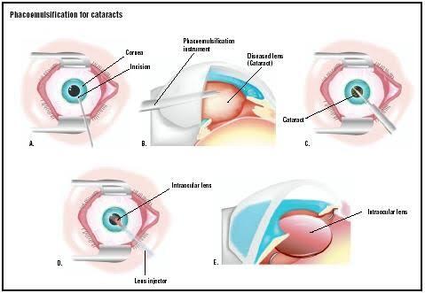 Cataract-Surgery-Mechi-Netralaya